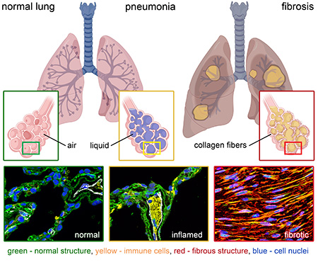 lung tissue progression from healthy to inflamed to fibrotic