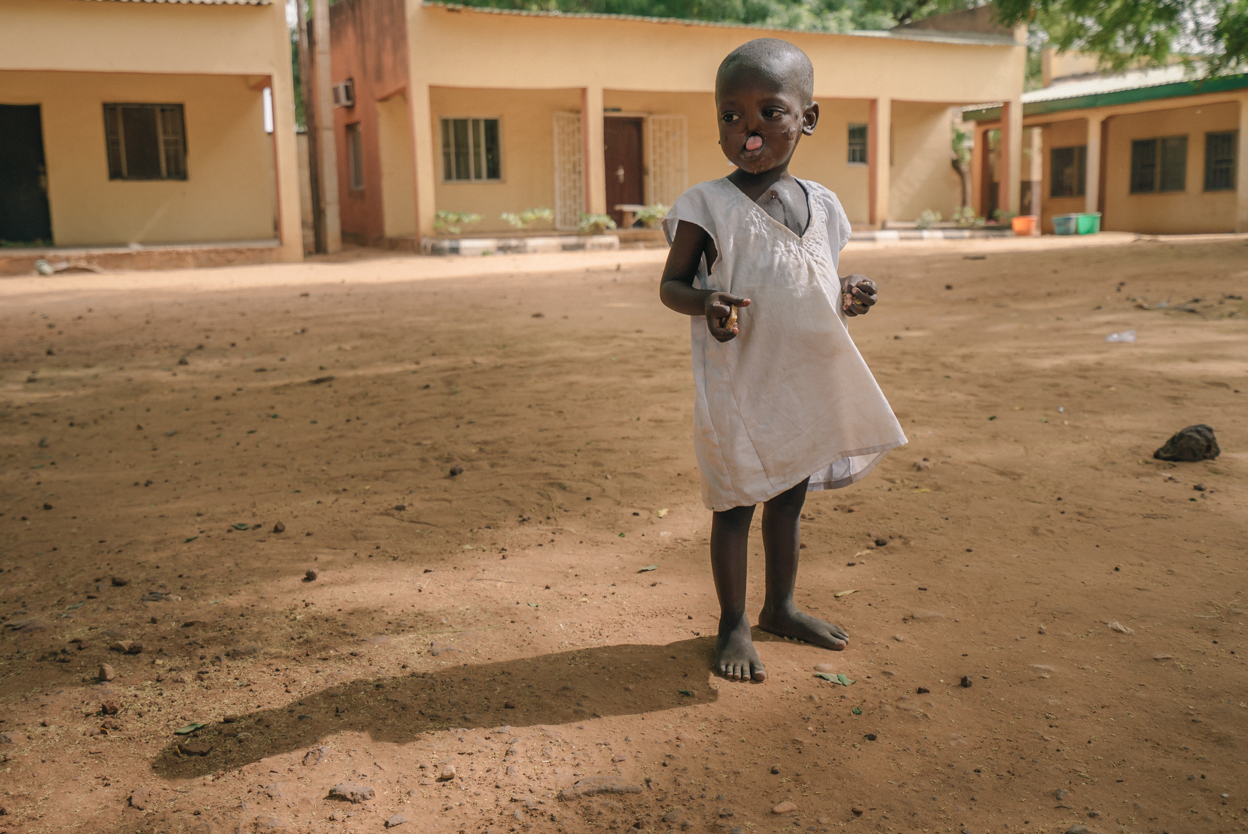 Sufyanu, a child with noma in Sokoto, Nigeria (credit Inediz, Claire Jeantet and Fabrice Caterini)