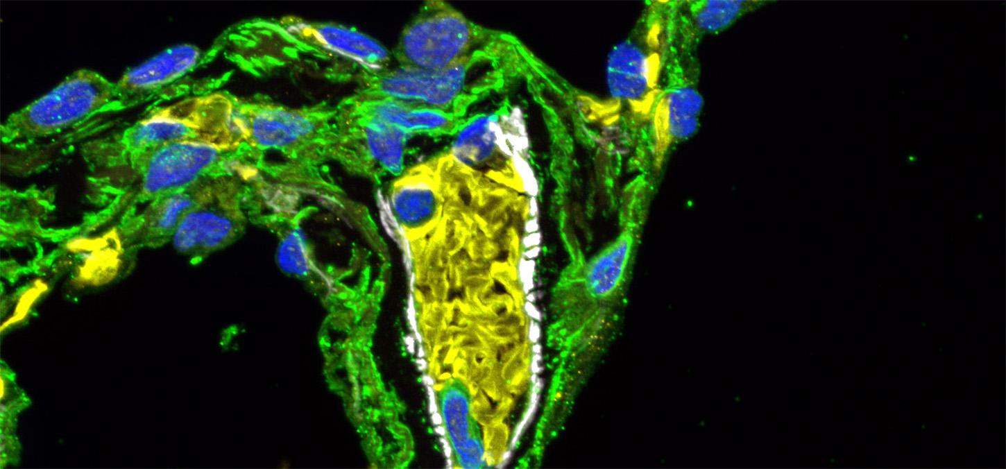 inflamed lung tissue