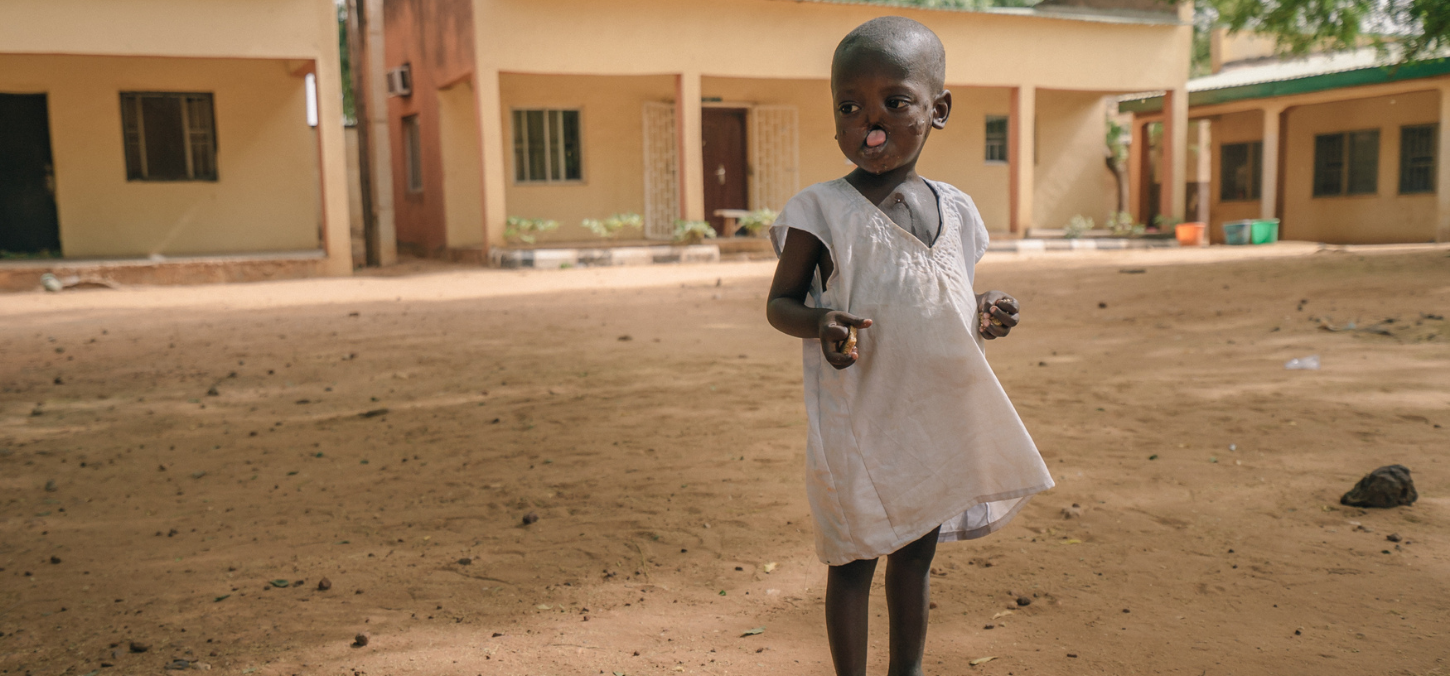 Sufyanu, a child with noma in Sokoto, Nigeria 