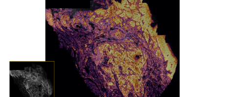 spatial transcriptomic analysis of oral cancer samples under the microscope